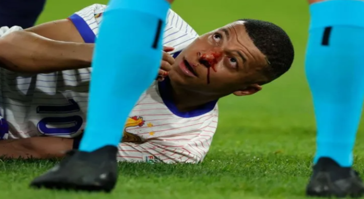 Kylian Mbappé jugará con máscara en la Eurocopa 2024; no será operado tras su fractura de nariz Kylian Mbappé jugará con máscara en la Eurocopa 2024; no será operado tras su fractura de nariz