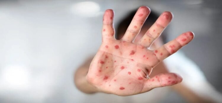 Confirman 4 casos de sarampión en Edomex