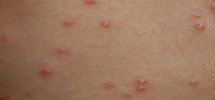 Casos de varicela en Edomex reportados durante noviembre